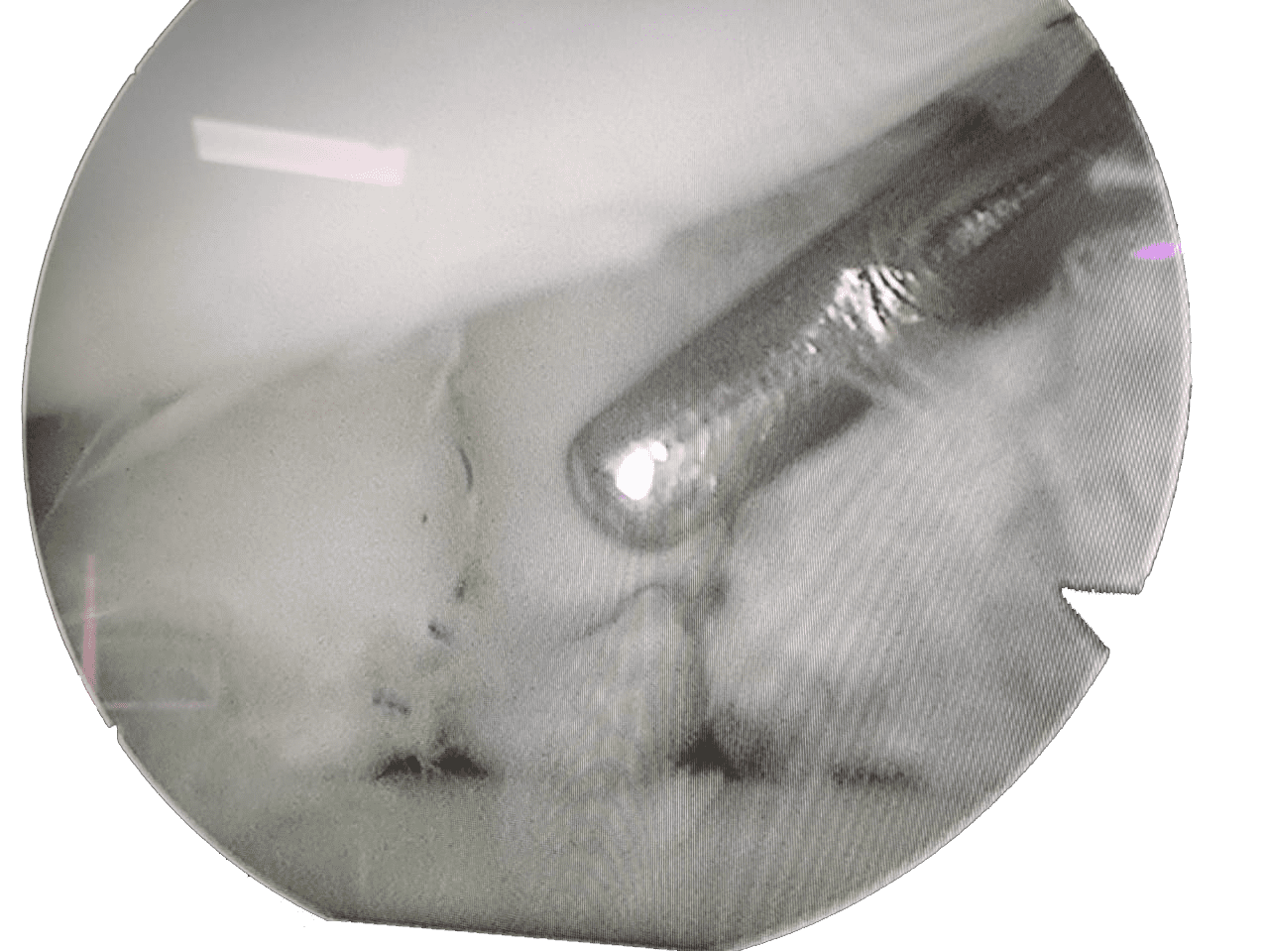 How much is the recovery time after a meniscus surgery