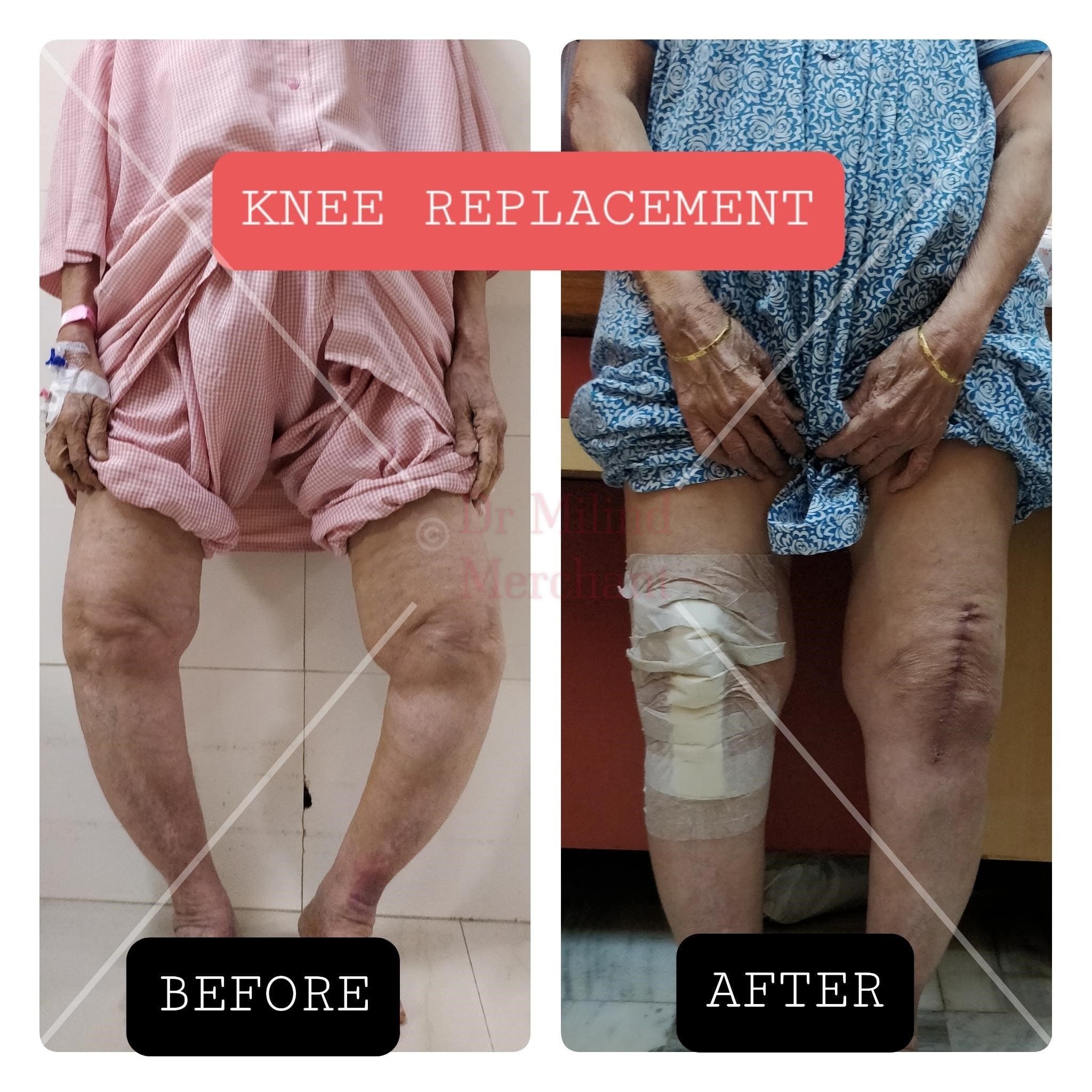 Knee Replacement