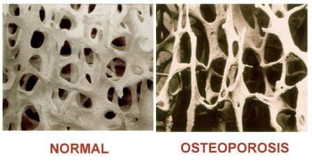 Osteoporosis