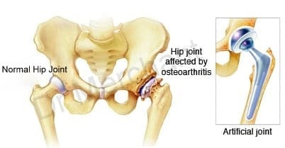 Hip Replacement